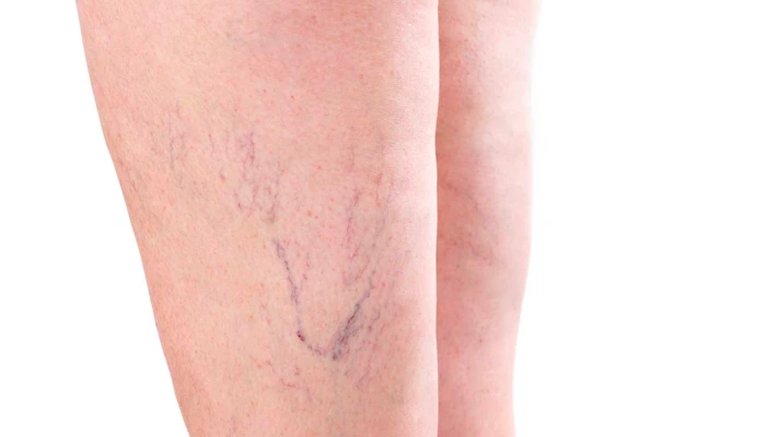 Eliminar varices, cirugía vascular, Varicentro Barcelona, Eliminación del vello, Elegansse, medicina estética Barcelona, medicina estética Gavá Mar y medicina estética Santander.