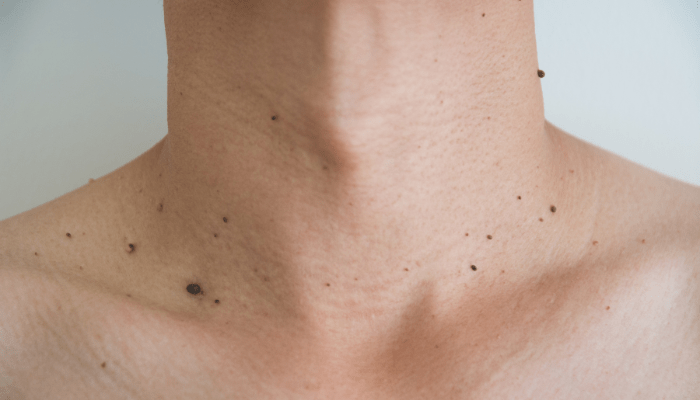 Elimina verrugas y lunares con seguridad en Elegansse. Expertos en dermatología estética te ofrecen soluciones efectivas.
